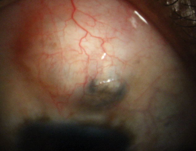 A higher PRS was also associated with an increased requirement for glaucoma surgery.