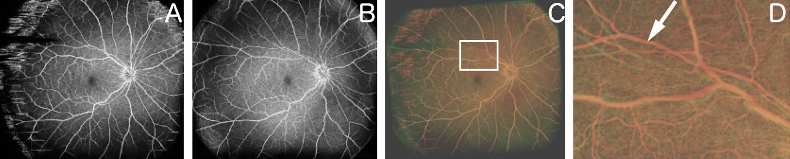 Using widefield OCT angiography to observe vessel tortuosity changes can aid in the identification of early postoperative proliferative changes in eyes with rhegmatogenous retinal detachment. These images from the study show: (A) an OCT-A image obtained one month after RRD repair, (B) another obtained two months after surgery, (C) overlaid image after changing A and B to red and green, respectively, and (D) a magnified image of the superior area of C, where white arrow indicates retinal vessel tortuosity change. 