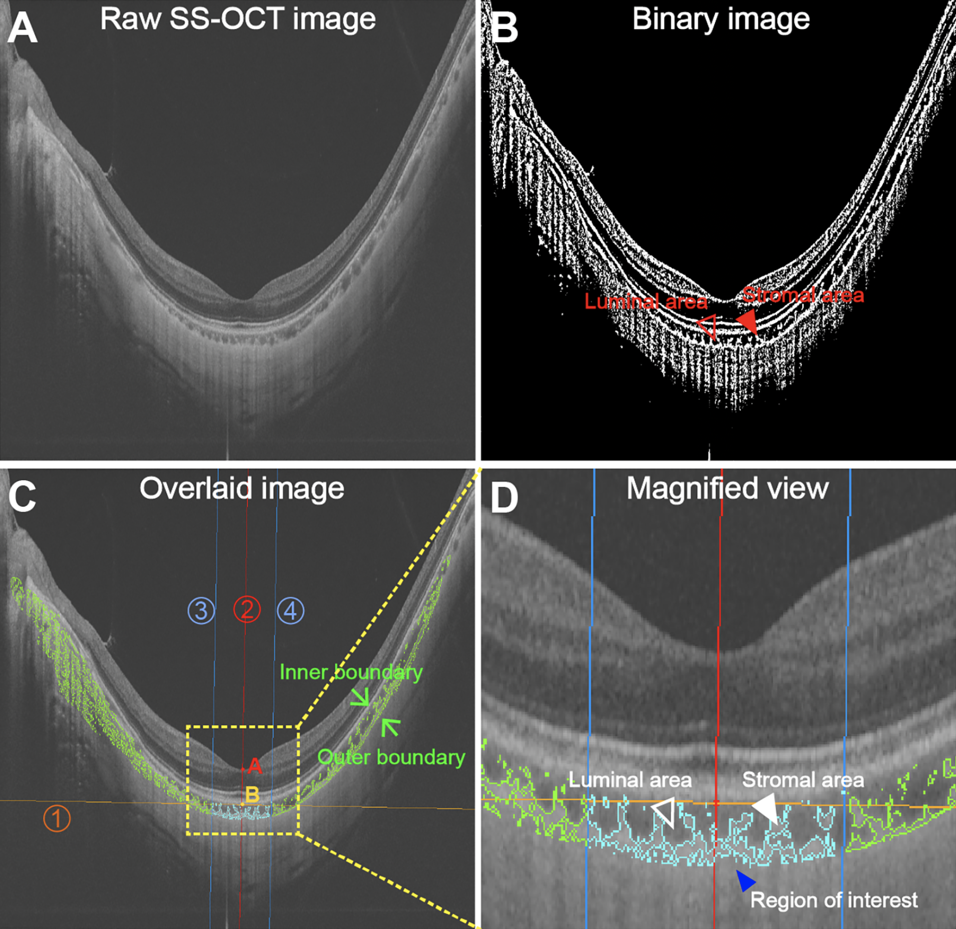 For every 10-μm increase in subfoveal choroidal thickness and each 1% increase in choroidal vascularity index, this study noted an associated decrease in axial length elongation of 0.007mm and 0.010mm, respectively. This image from the study shows (A) raw SS-OCT image, (B) converted binary image with luminal area and stromal area indicated, (C) annotations of foveal center at point A and the choroidal inner boundary closest to the fovea center at point B, and (D) Aamagnified view of the choroid in the foveal region. The 1500μm-wide choroidal region of interest is indicated by a blue arrowhead, the choroidal luminal area is indicated by an empty arrowhead and the choroidal stromal area is labeled by a closed white arrowhead.