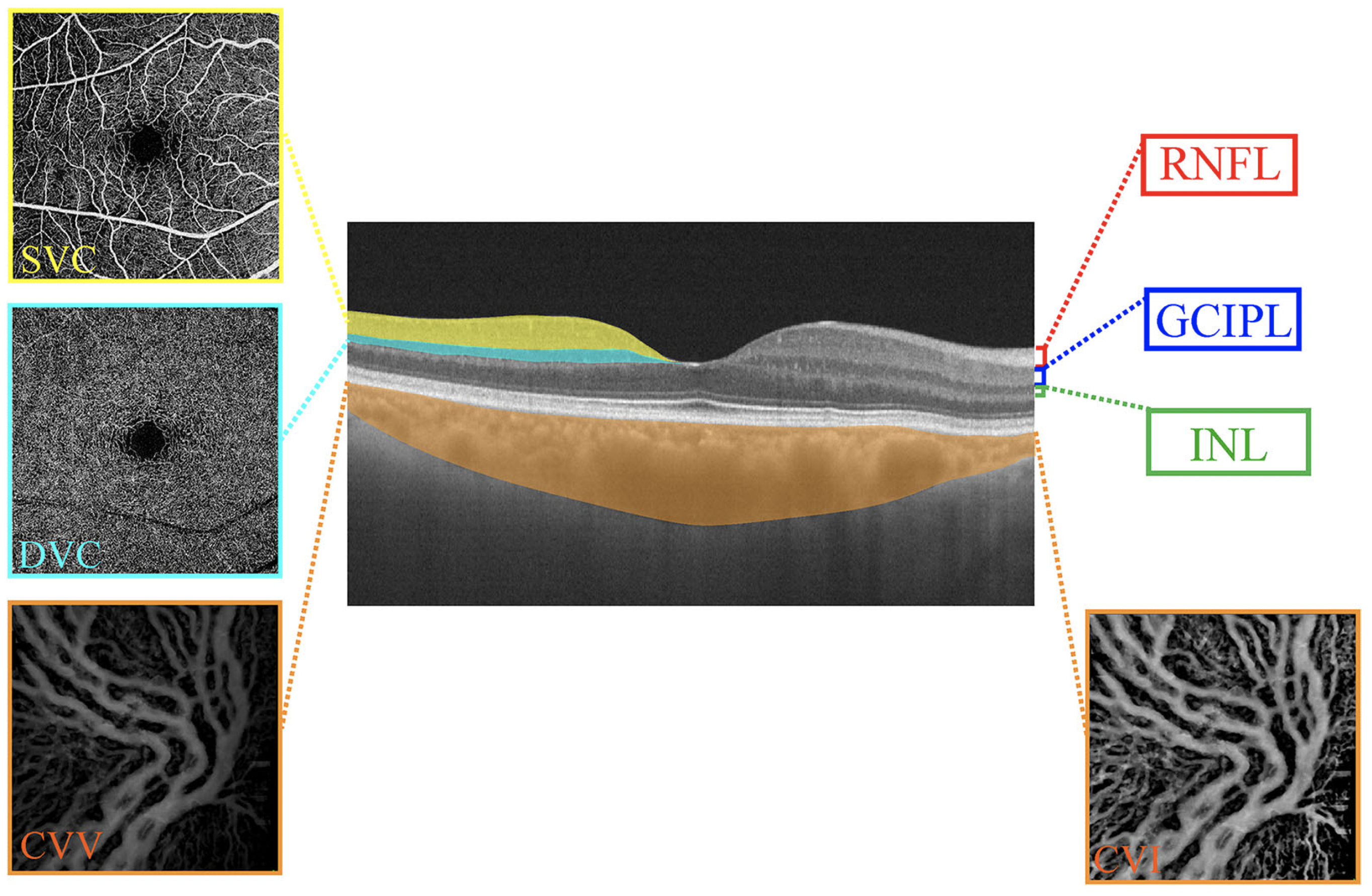 This analysis revealed a rapid and significant increase in superficial vascular complex density and choroidal vascular volume in ipsilateral eyes following carotid artery stenting. 