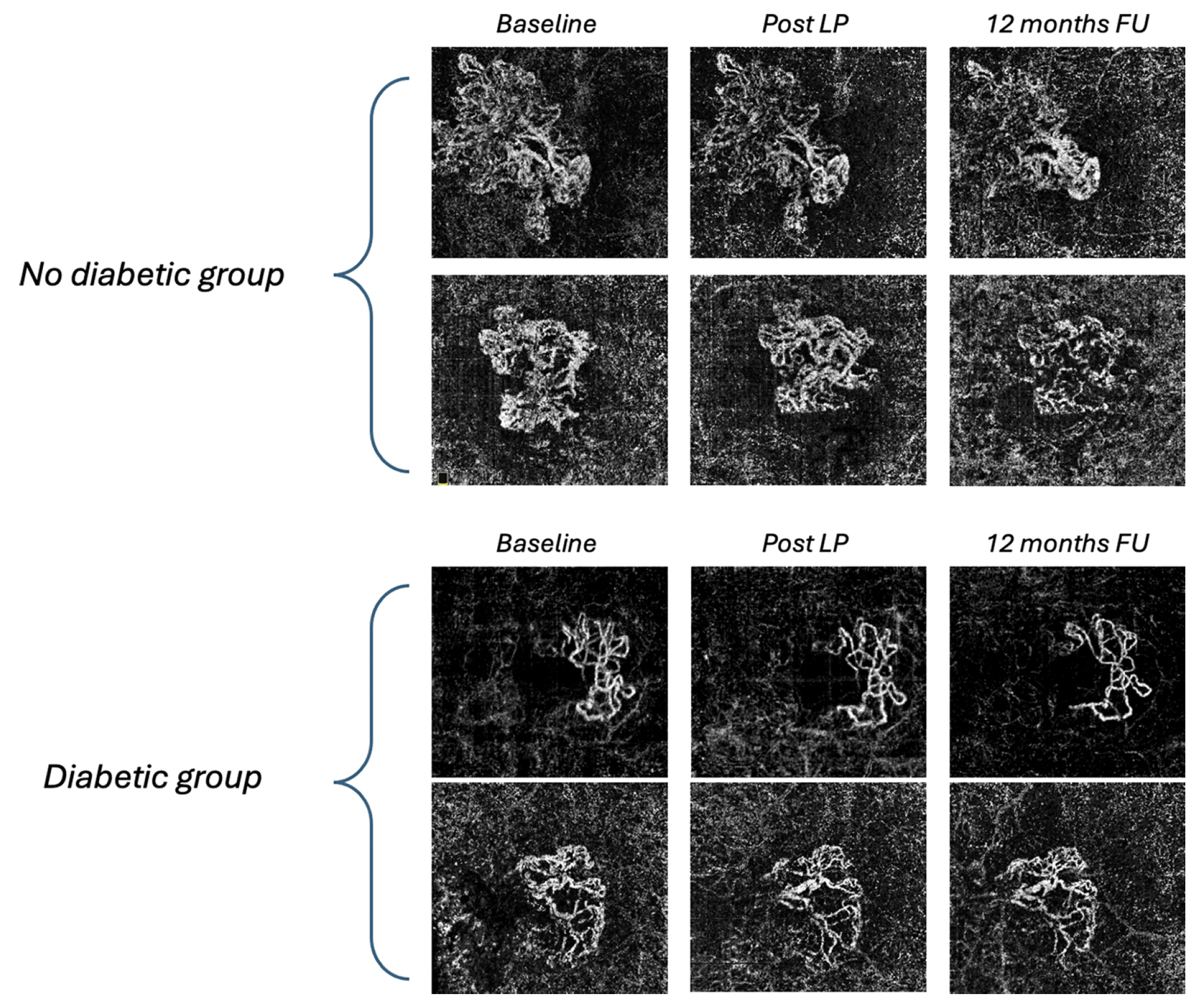 In a recent study published in the journal Investigative Ophthalmology & Visual Science, researchers followed two groups of patients with nAMD (one with mild DR, and the other without) who received anti-VEGF therapy for one year. Their most significant discovery was in the size of macular neovascularization lesion size, which continued to decrease in the non-diabetic group over the course of 12 months, but had a smaller decrease in the diabetic group, suggesting the disease may be a risk factor to consider during anti-angiogenic treatment.