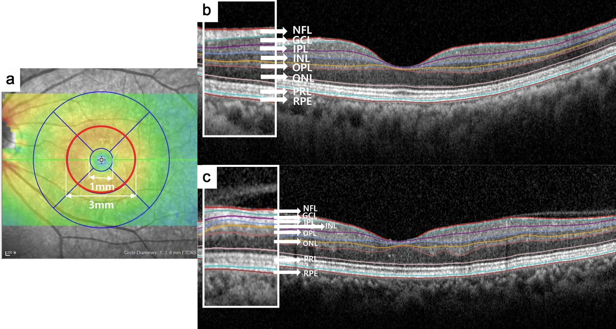 Changes in the GCC, outer plexiform layer and ONL also were significantly associated with BCVA; these relationships have not been previously reported. This image from the study shows: (a) the parafoveal area (red circle) ranging from 1mm to 3mm from the subfoveal region, that was analyzed, (b) a representative B-scan image of the control group and (c) and the CRVO group.