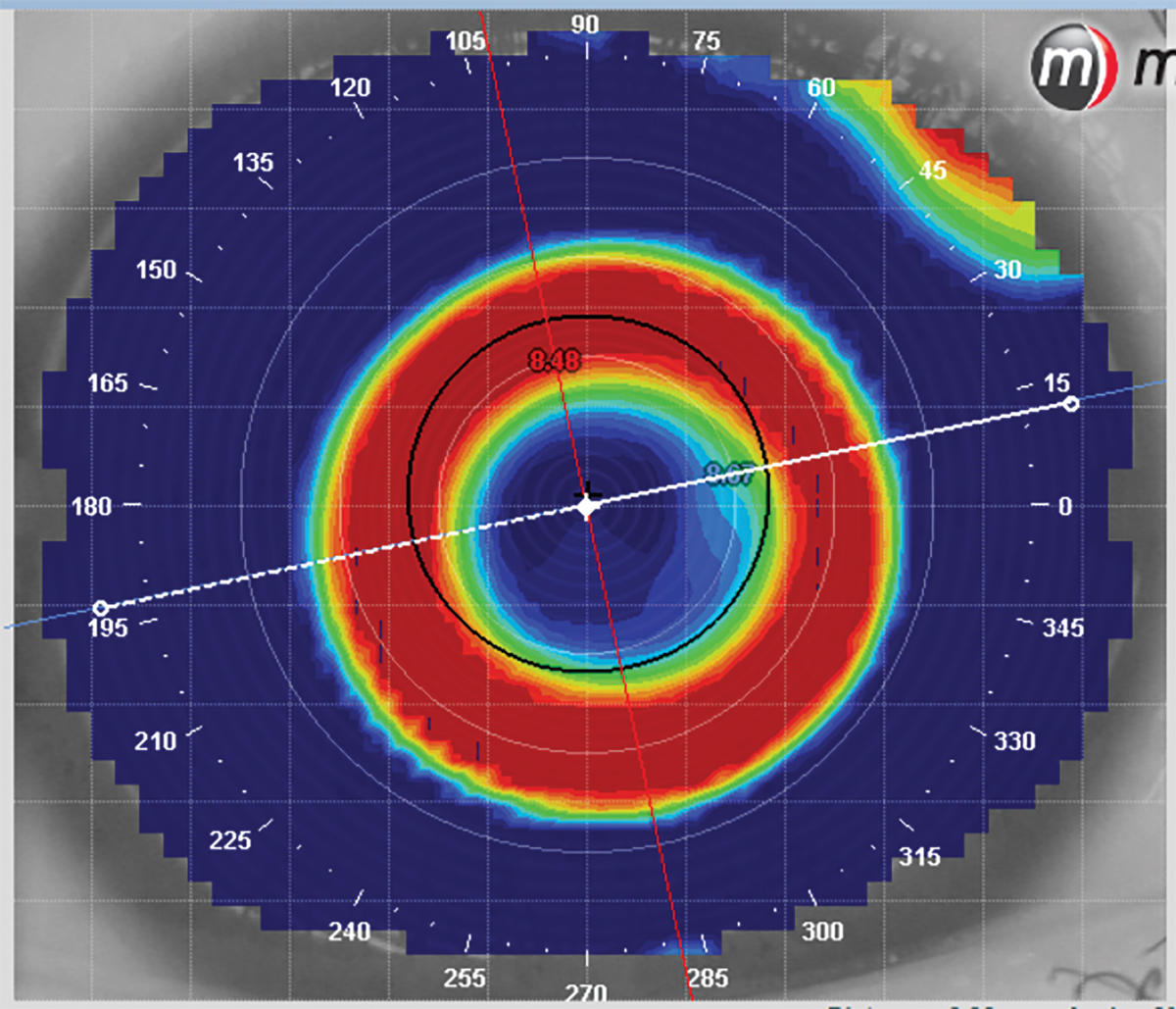 Post-treatment ortho-K image. Analyzing the post-treatment topography is important to assess how the lens is performing.