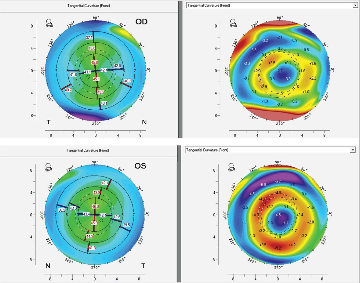 Fig. 3. Baseline corneal topography (top and bottom left) and after ortho-K wear (top and bottom right) both OD (top left and right) and OS (bottom left and right).