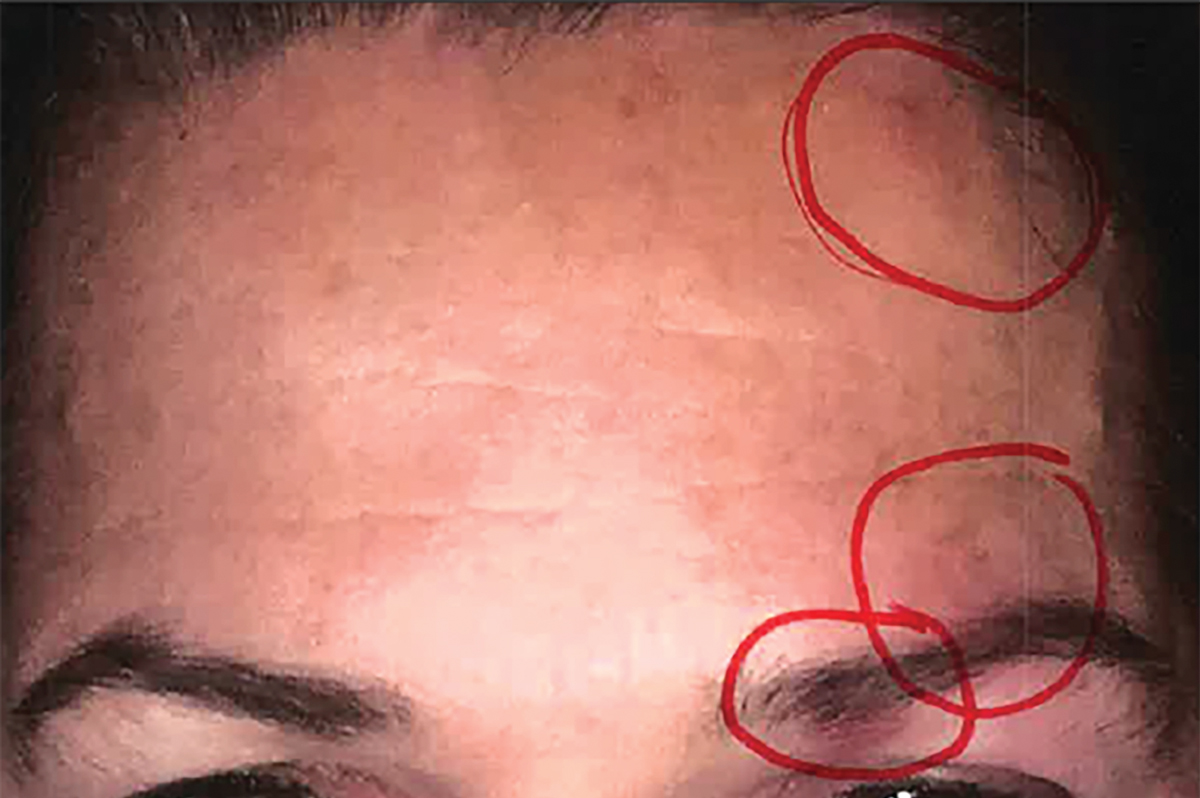 Fig. 1. The patient has acne lesions on both halves of the face but HZO on only the left side, with the circles highlighting rash/blisters. The three red circles were drawn by the neuro-ophthalmologist on the iPhone image taken a day prior to the exam in question.