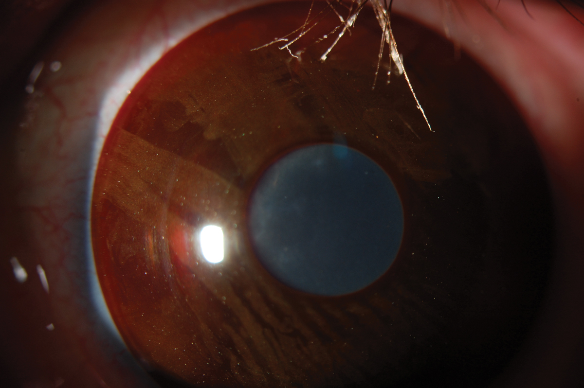 Fig. 1. A soft prosthetic contact lens for aniridia.