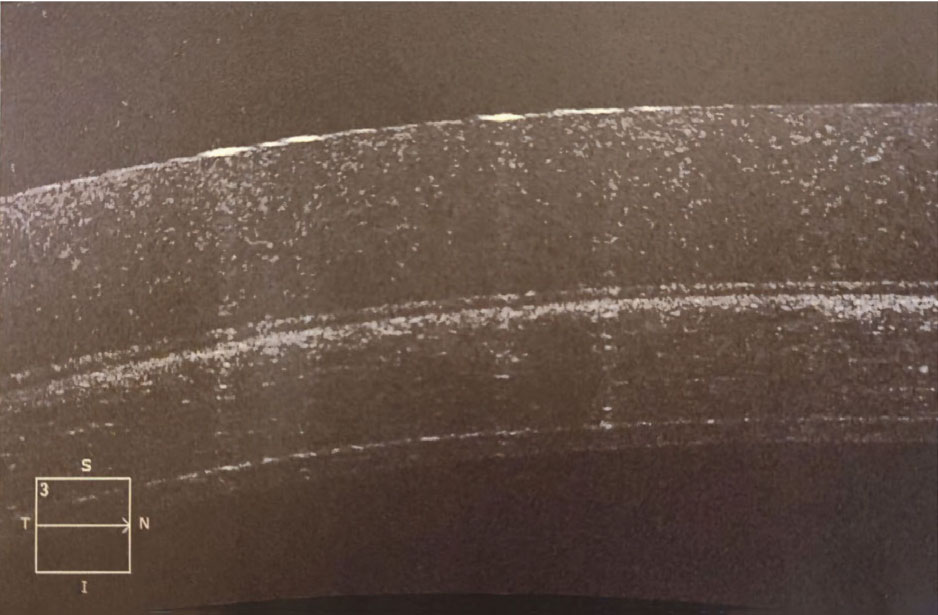 Anterior segment OCT of a specialty soft keratoconus contact lens on the eye demonstrating the thickness of the lens.