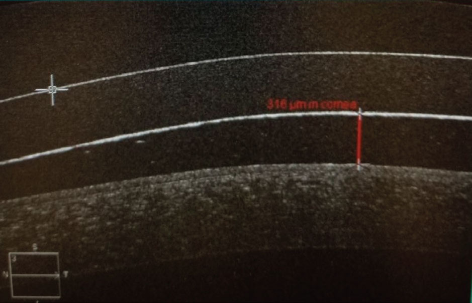 OCT image of a scleral lens evaluating lens vault over the cornea.