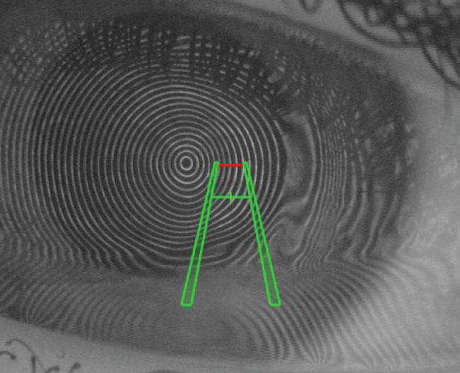 Decentration and distortion of mires in a corneal topography in vivo. Angle kappa should be considered. Guiding patients to blink and turning their heads contralateral to the eye measured helps address the issue.