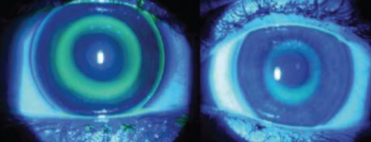 Comparison of the back optic zone diameter (BOZD) between 6.0mm and 4.8mm. Selection of a relatively smaller BOZD for children has shown to augment the amount of peripheral defocus signaling, which is believed to help slow axial length progression.