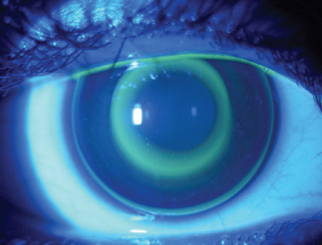 Optimal NaFl distribution for an ortho-K lens fit in a child. Note that the mid-peripheral ring with NaFl pooling is designed to be more coincided with the pupillary margin to optimize the projected mid-peripheral defocus signal compared to the fit for young adults.