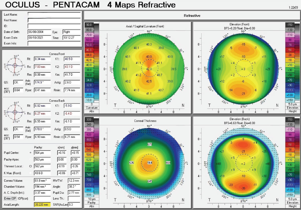 An overview of a four-map comparison depicting keratometry, pachymetry, anterior and posterior elevation.