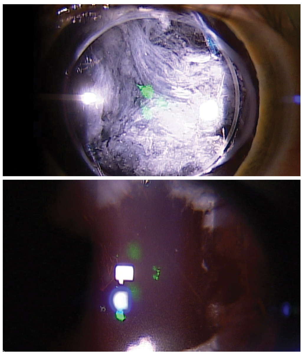 Fig. 3. Preoperative appearance of a significant grade 4 PCO (top), as well as the appearance of the capsule at the end of the procedure (bottom). Visual acuity improved from hand motion to 20/30. 