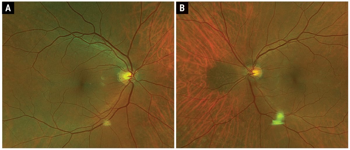 Fig. 1. Optos fundus photo of the right (A) and left (B) eye.