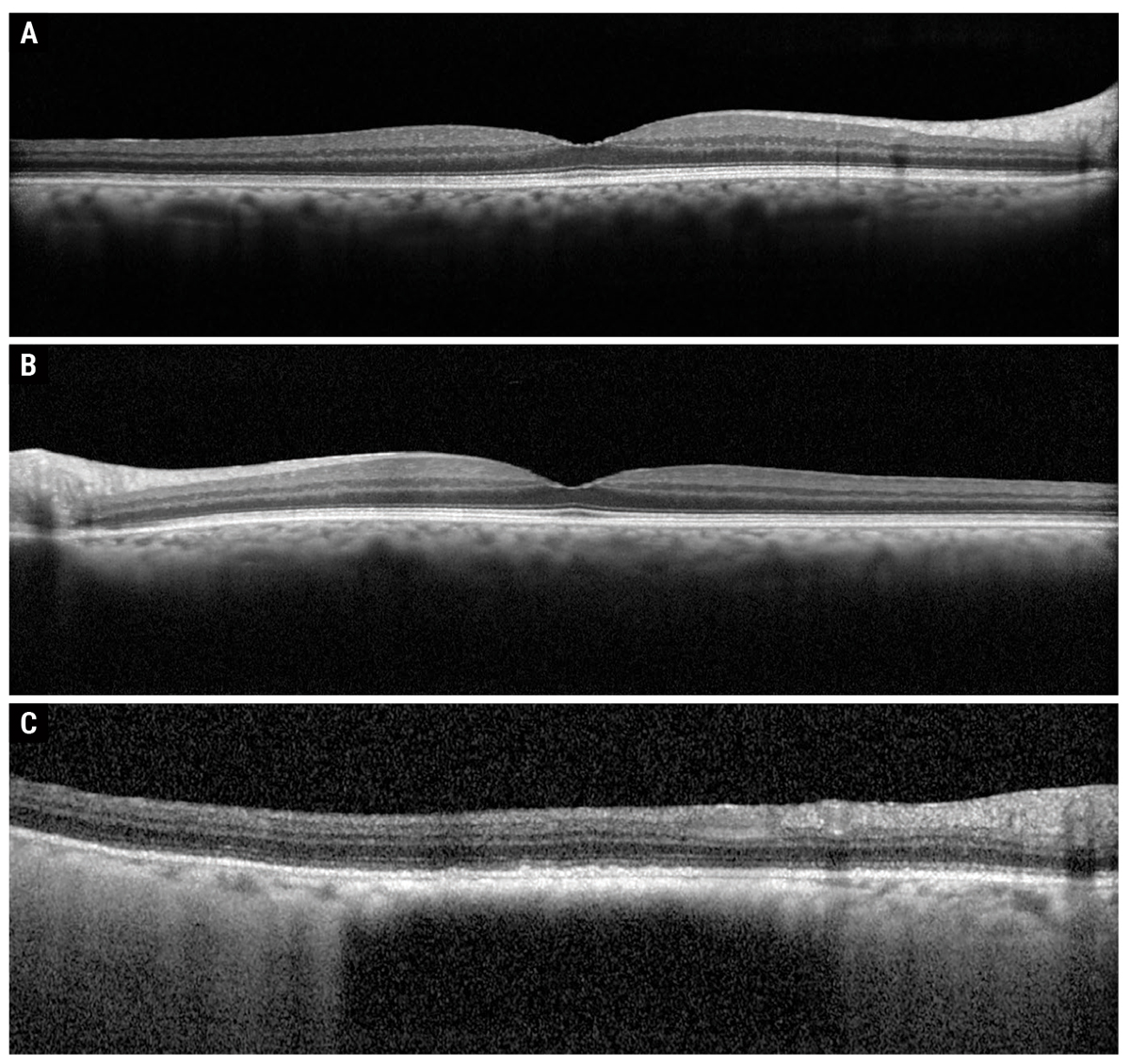 Fig. 2. Heidelberg OCT of the right macula (A), left macula (B) and peripapillary lesion (C).