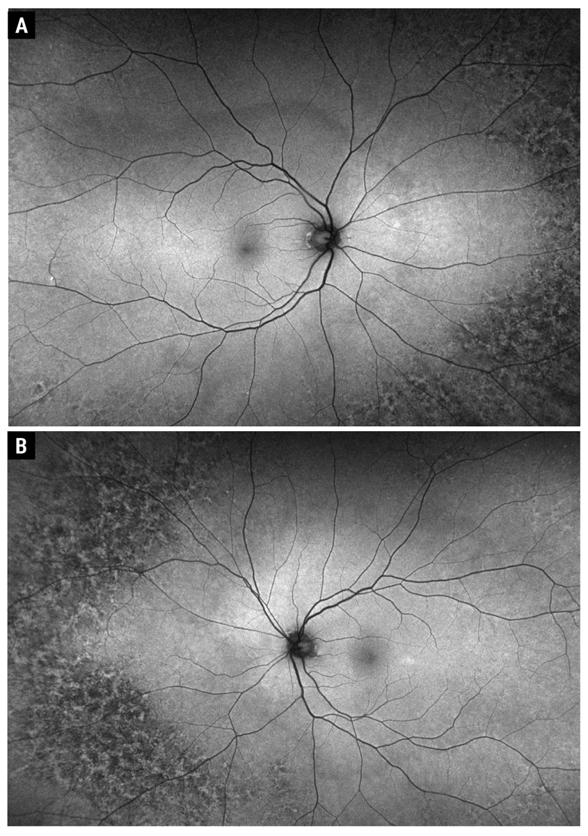 Fig. 3. Optos fundus autofluorescence of the right (A) and left (B) eye.