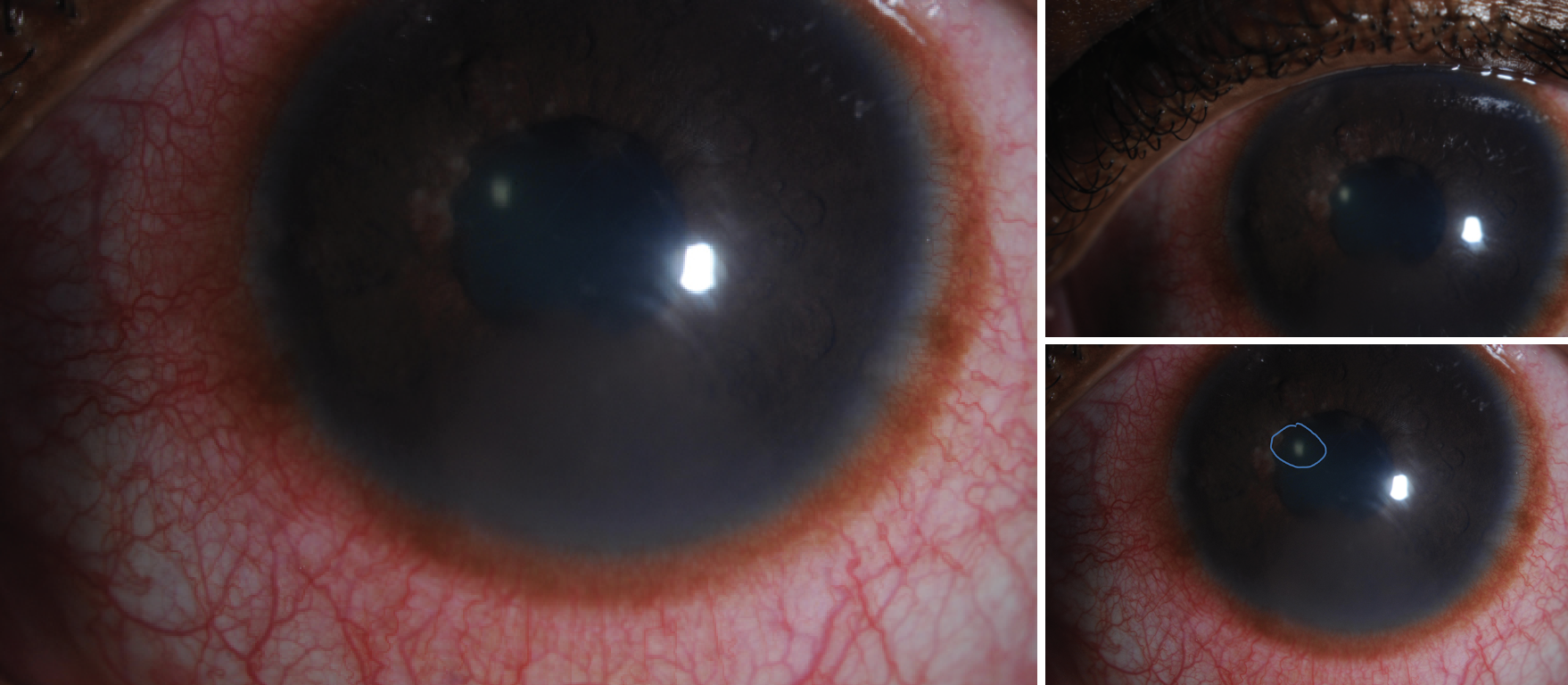 Fig. 3. A close-up view of a patient’s eye reveals an infectious corneal infiltrate with a moderately severe conjunctival injection. The cornea appears slightly hazy, with a distinct grayish-white spot indicating the presence of an infiltrate.