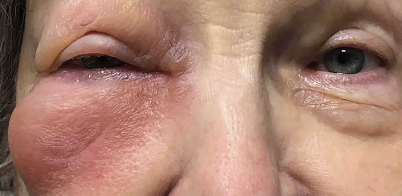 Preseptal cellulitis in a patient with an incipient chalazion.