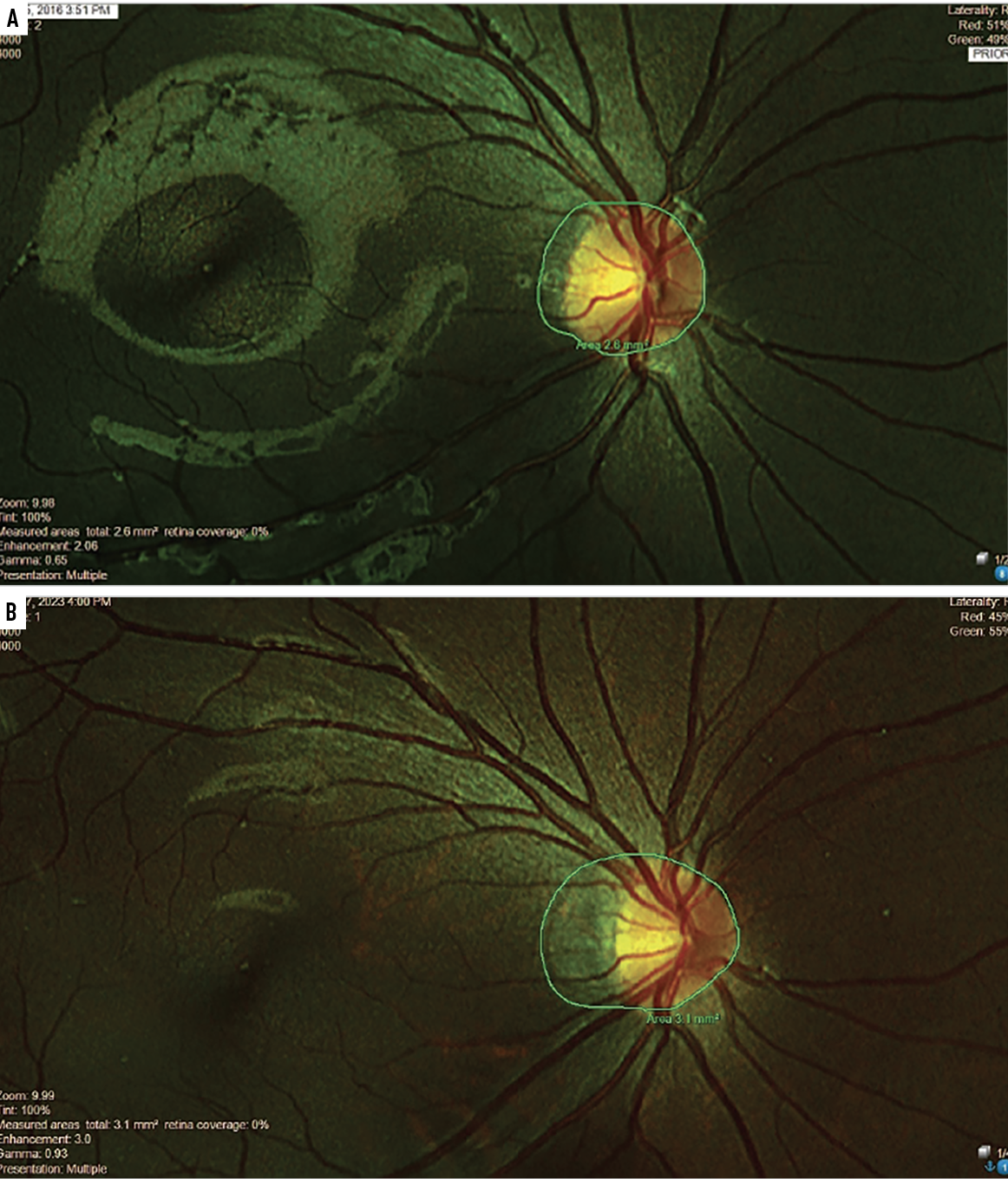 Fig. 3. Contrary to the treated patient shown on page 12, this nine-year-old patient refused treatment for seven years and instead opted for standard single-vision spectacles and occasional progressive addition lenses. The area of atrophy appreciably increased from year two (A) to year nine (B).