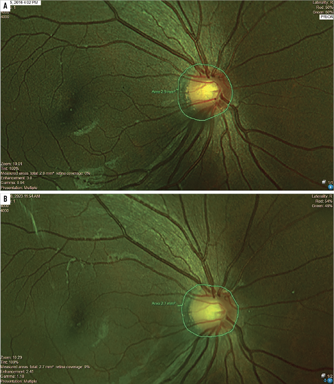 Fig. 2. This nine-year-old child with myopia was effectively treated with multifocal contact lenses for seven years, during which she had about -0.25D total myopia progression and stable axial lengths. The serial analysis of the area of peripapillary choroidal atrophy shows virtually no change from before treatment (A) to seven years later (B).