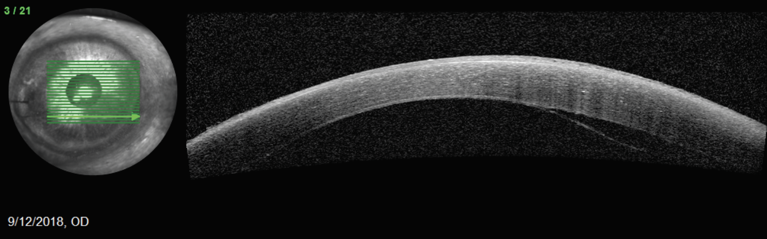 AS-OCT can be a useful tool in pre- and postoperative management. Shown here is an inferior dehiscence of DMEK graft.