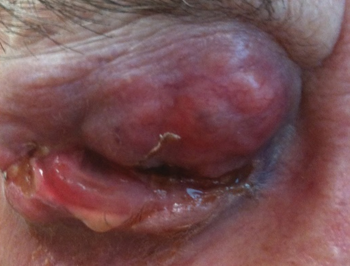 A recent research effort underscores the high recurrence rate among patients with eyelid sebaceous carcinoma, occurring in approximately four in 10 cases.