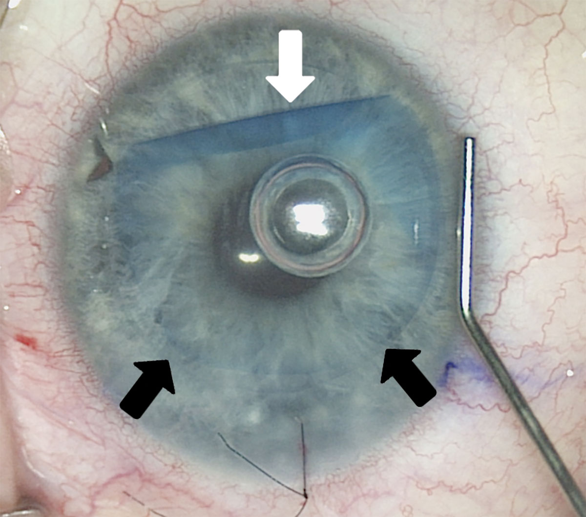 DMEK rates nearly doubled from 2012 to 2023, from 48% to 82% of keratoplasties, respectively.