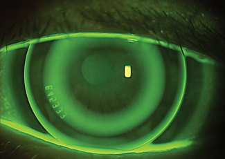 Compared to ortho-K lenses with a conventional treatment zone, this study found that small treatment zone lenses more effectively reduced axial elongation at both 12 and 18 months of follow-up. Additionally, since the measurement was affected by retinal visual quality, the authors suggest axial elongation may help explain how ortho-K prevents myopia progression.