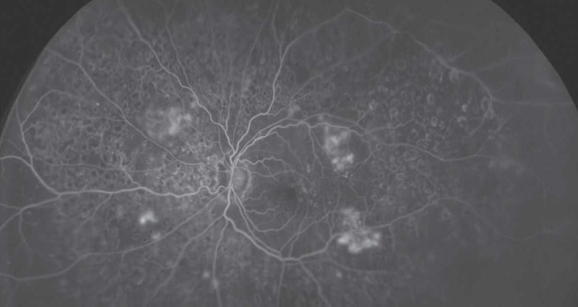 Predominantly peripheral lesions, especially severe hemorrhages/microaneurysms and intraretinal microvascular abnormalities, showed a strong association with the progression of diabetic retinopathy in this study, emphasizing the value of using ultra-widefield FA imaging to assess these patients.