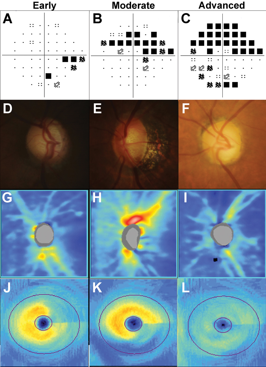 A reduction of vision-related QoL among patients with preperimetric glaucoma would have broad implications for the management of patients classified as glaucoma suspects or early glaucoma.