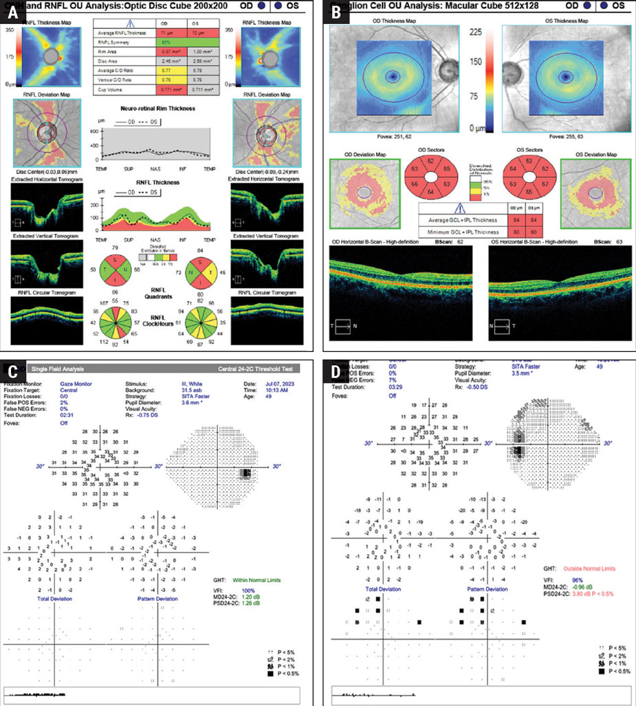 The 24-2C SITA Faster had good accuracy in detecting defects in mild-stage glaucoma, with 96.1% of patients found to have either central or beyond 10° VF defects.