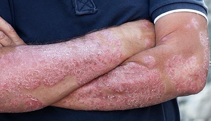 In the study, psoriasis was a risk factor for neovascular AMD even after adjusting for age, sex, BMI, income level, smoking and drinking status, regular exercise habits, hypertension, dyslipidemia, end-stage renal disease, diabetic retinopathy, glucose level, more than three oral hypoglycemic agents and a history of diabetes mellitus greater than five years. 