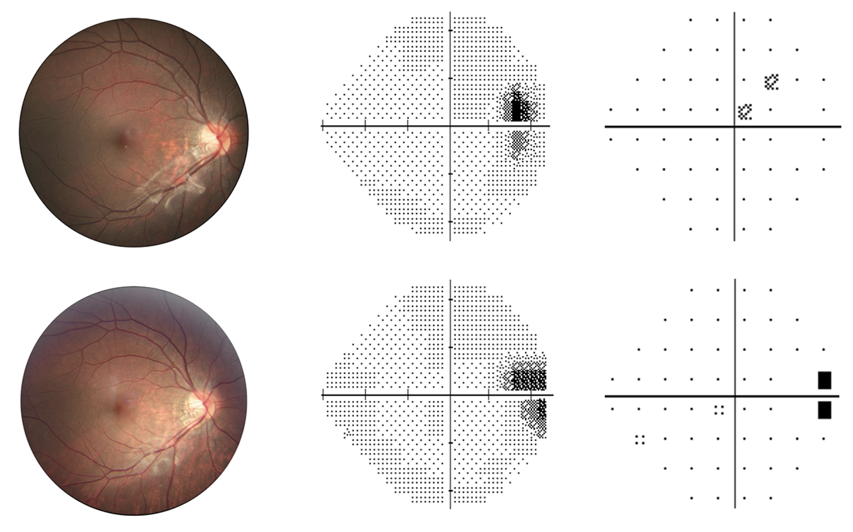 Enlarged blind spot was the most common form of visual field defect observed in this study of high myopes over an eight-year period.