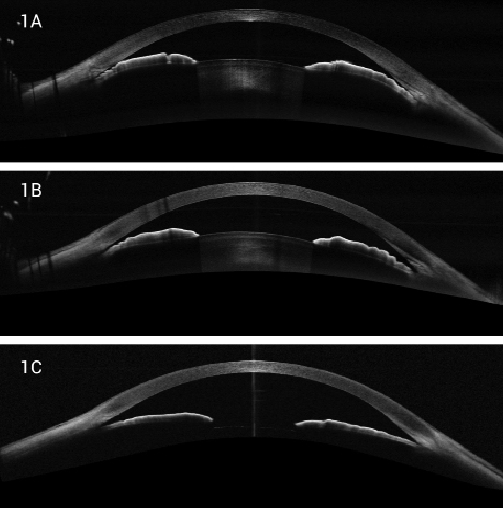 Researchers found lens thickness to be a predictive factor for the occurrence of primary angle-closure disease, agreeing with prior investigations.