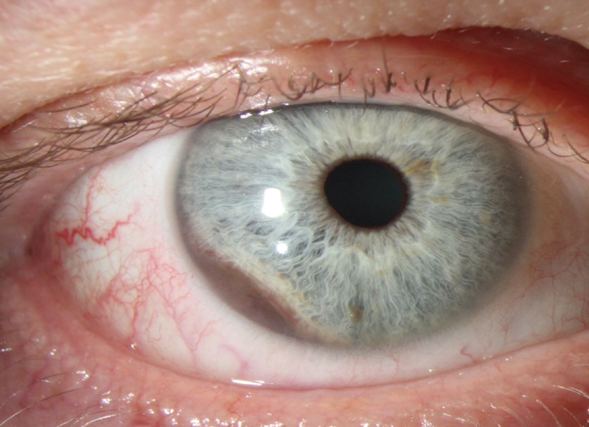 Clinicians know to be more vigilant for uveal melanoma in blue-eyed patients, and this research helps explain the genetic associations that give rise to the elevated risk. 