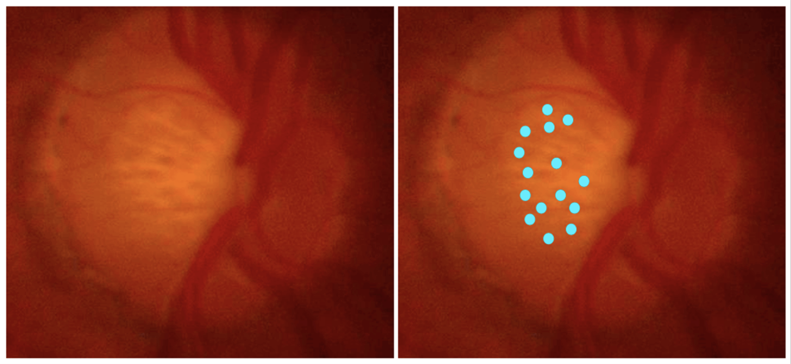 Changes in lamina cribrosa pore parameters appear to be associated with the severity of glaucomatous optic neuropathy.