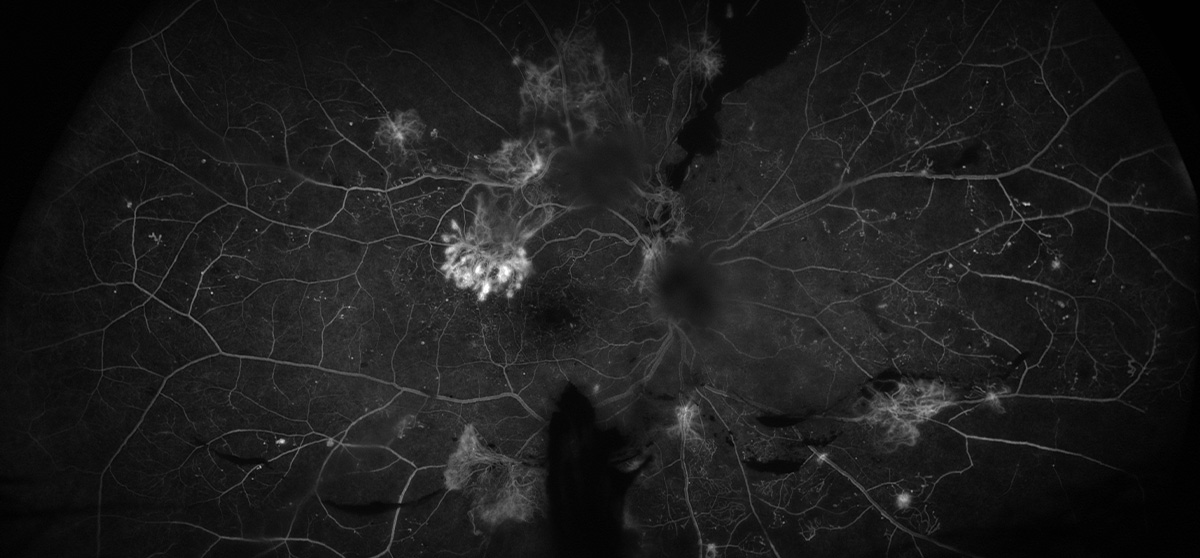 This study underscores the need for focused strategies to address socioeconomic gaps in access to care for those with diabetic retinopathy.