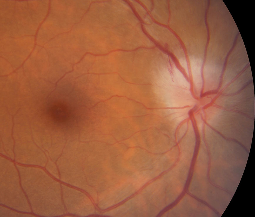 A recent South Korean population-based study, published in Ophthalmology, found that optic neuritis cases significantly decreased in the years following the COVID-19 pandemic. However, the research revealed a notable rise in ON cases associated with autoimmune diseases, such as multiple sclerosis, neuromyelitis optica and acute disseminated encephalomyelitis, suggesting a complex relationship between vaccines and neuro-ophthalmic conditions.