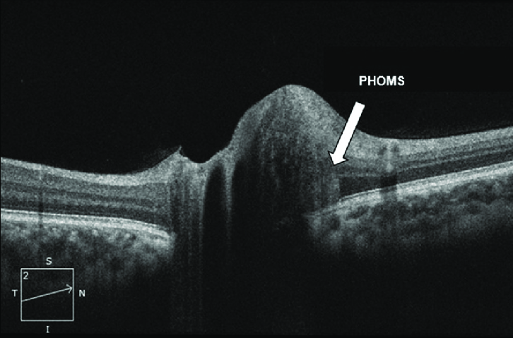 New research suggests that idiopathic intracranial hypertension is more pronounced in patients previously diagnosed with isolated PHOMS, necessitating ongoing assessments.