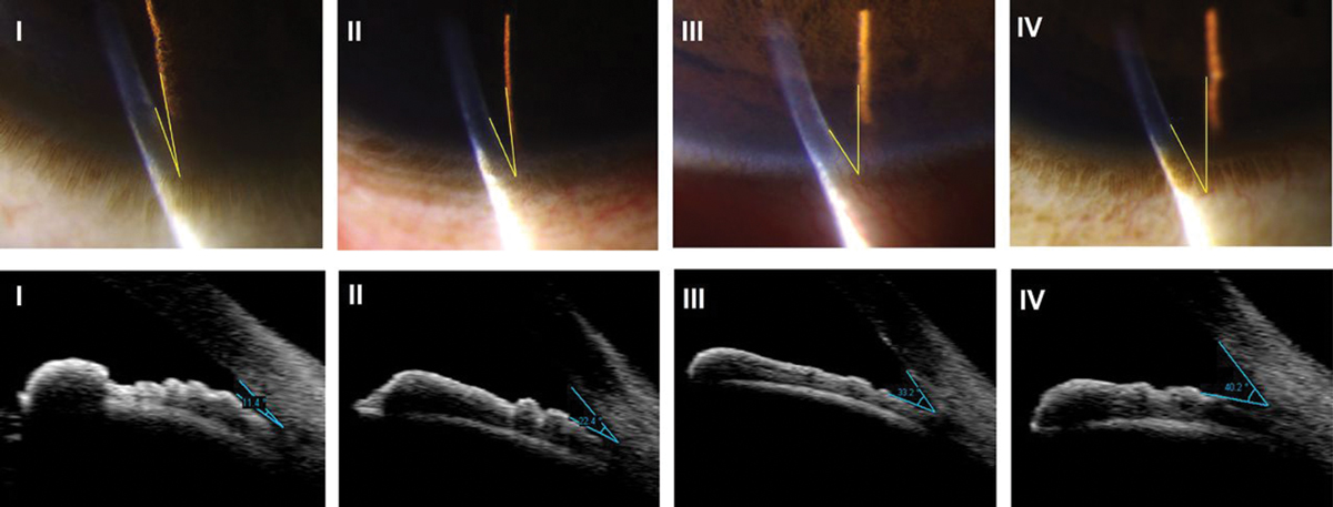 A shallow anterior chamber depth of <2.2mm was associated with increased PCR rates, possibly due to iris prolapse being more common, thus surgeons making longer tunnels and increasing corneal distortion and impairing visualization, or more directly increasing proximity of instruments to the posterior capsule in a shallow anterior chamber. Shown here is the Van Herick grading stages.