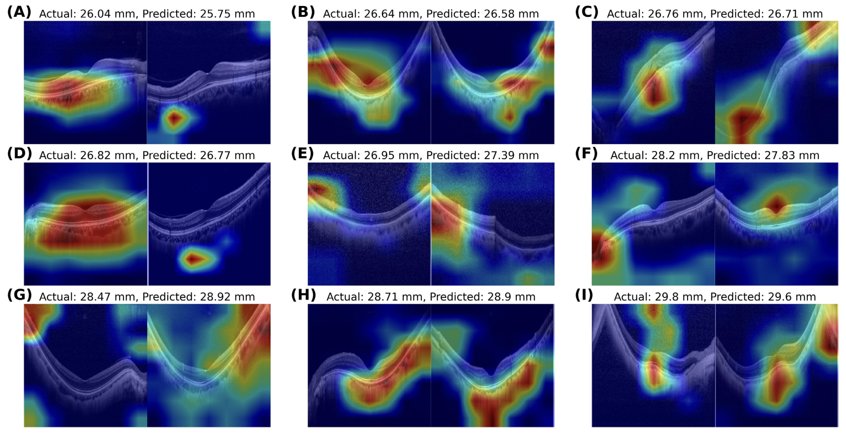 This novel model demonstrated impressive performance and could possibly be used not only for accurate AL prediction based on OCT images but also for investigating how retinal and choroidal structures are related to AL elongation. This image from the study—a heatmap analysis of myopic eyes with axial length greater than 26.0mm—shows the actual and OCT-predicted values for nine subjects in the study.