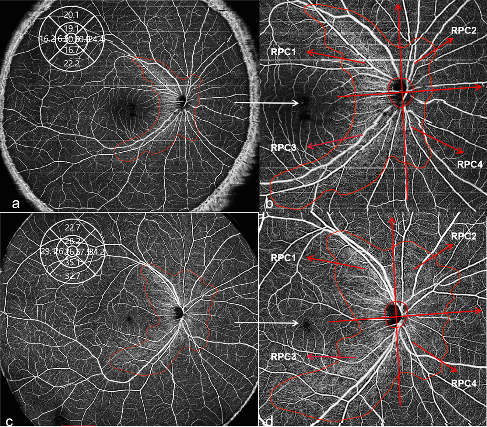 This study revealed a significant decrease in peripheral superficial retina vascular density and the area of radial peripapillary capillaries in high myopes. This image from the paper shows radial peripapillary capillaries in high myopia (a, b) and low myopia (c, d).