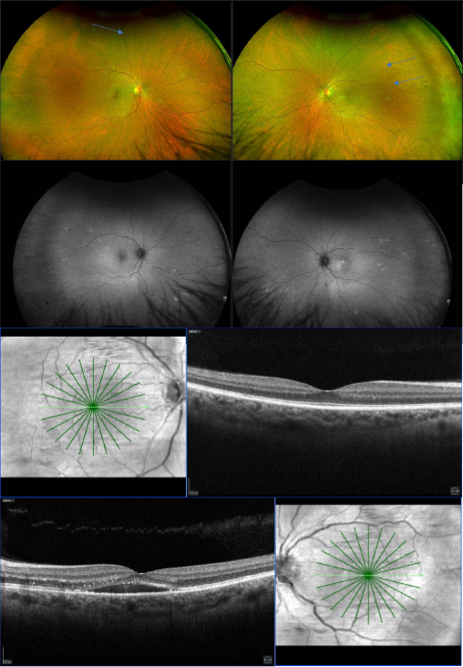 Top images show color photos and fundus autofluorescence in hypertensive retinopathy. The blue arrows correspond to Elschnig spots. The bottom OCT images show the right eye is normal and the left has a neurosensory detachment with subretinal fluid. 