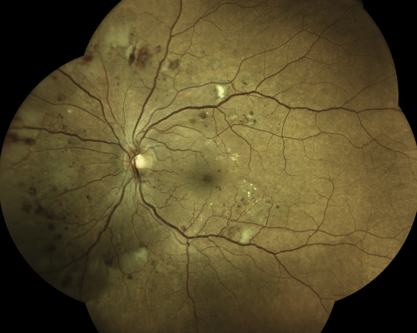 While using PRP and anti-VEGF injections in the initial treatment of proliferative diabetic retinopathy is an approach gaining popularity among clinicians, the optimal order of these interventions remains to be investigated.