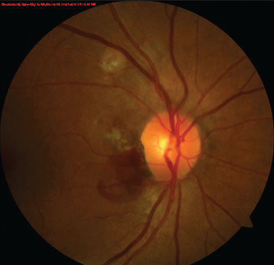 Choroidal neovascular membrane, produced in conditions like AMD, are linked with elevated MMP levels. Doxycycline can inhibit MMP synthesis on the ocular surface.