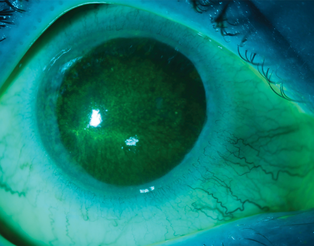 Fig. 1. Early AK with central corneal haze and superficial keratitis in another patient. 