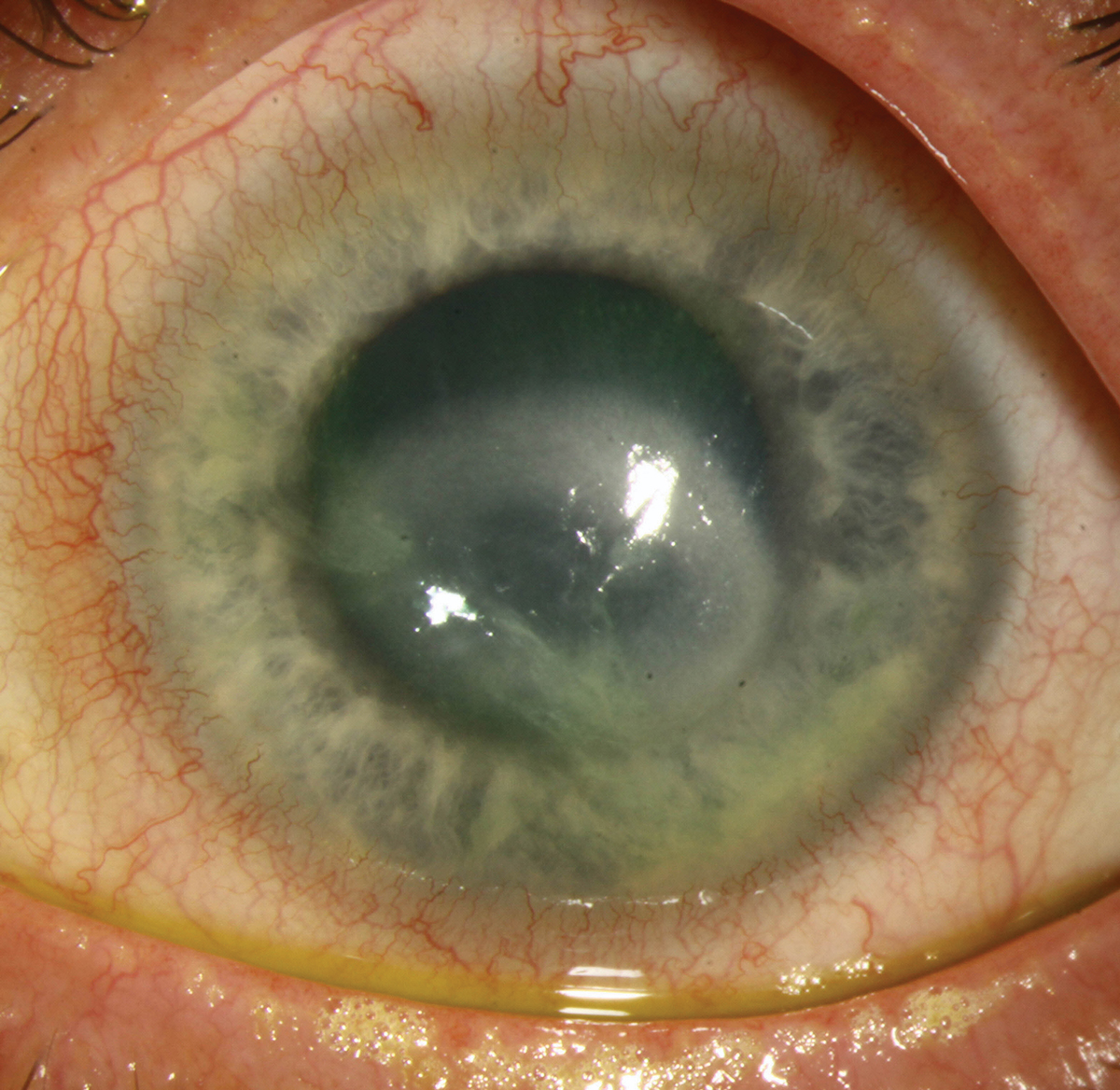 Fig. 2. Advanced AK with a ring infiltrate and central stromal haze in another patient. 