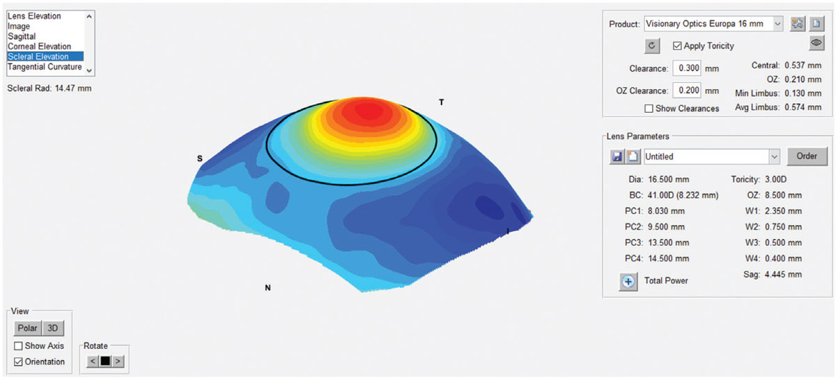 The sMap 3D scleral elevation map after image-stitching.