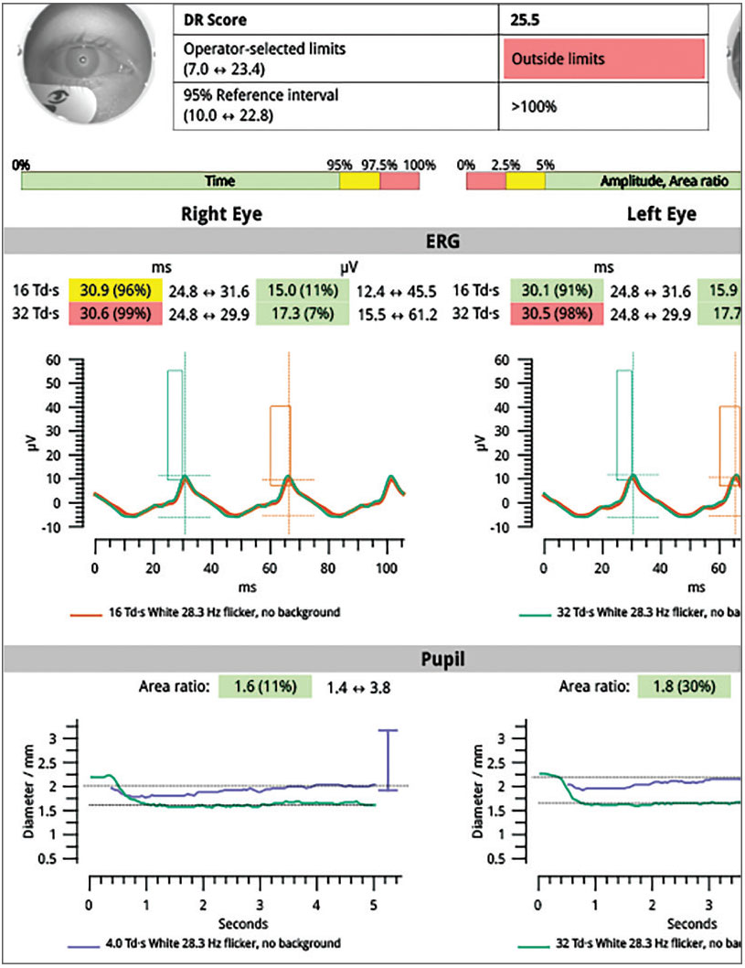 Full-field ERG wave form showing delayed signal (longer implicit time) and reduced amplitude. Diminished pupillary response differential between brighter and dimmer full-field ERG stimulus. 