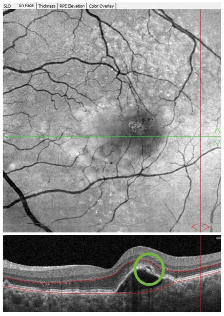 Fig. 3. Following a device alert three years into home monitoring, the patient returned to the optometry clinic for examination. A pigment epithelial detachment with overlying subretinal fluid (green circle) was observed on OCT imaging and anti-VEGF therapy was initiated upon retinal consultation.